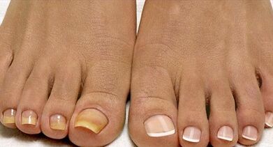 Metody leczenia grzybów floty